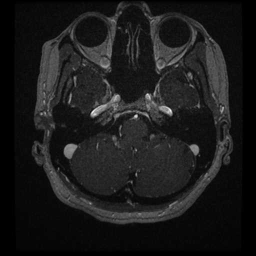 Anterior inferior cerebellar artery vascular loop - type II (Radiopaedia 70991-81209 Axial T1 C+ 64).jpg