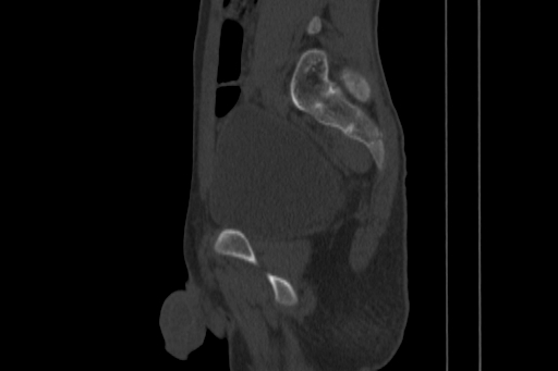 Anterior inferior iliac spine avulsion injury (Radiopaedia 88666-105376 Sagittal bone window 61).jpg