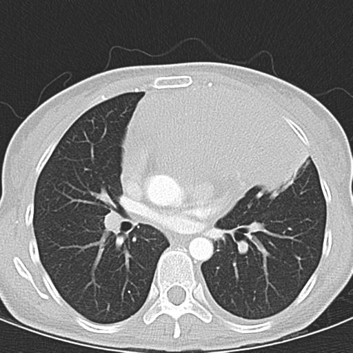 Anterior mediastinal lymphoma (Radiopaedia 29556-30061 Axial lung window 29).jpg