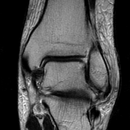 File:Anterior talofibular ligament rupture (Radiopaedia 15831-15484 Coronal T2 13).jpg