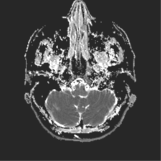 File:Anterior temporal lobe perivascular space (Radiopaedia 40946-43650 Axial ADC 4).png