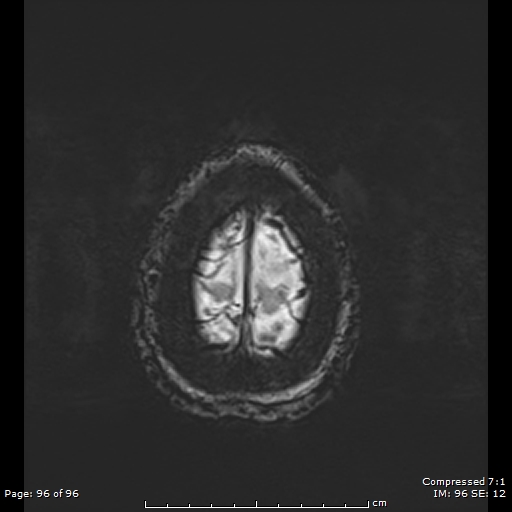 Anterior temporal lobe perivascular space (Radiopaedia 88283-104914 Axial SWI 65).jpg