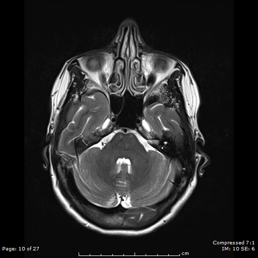 File:Anterior temporal lobe perivascular space (Radiopaedia 88283-104914 Axial T2 10).jpg