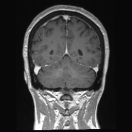Anterior temporal pole cysts (Radiopaedia 46629-51102 Coronal T1 C+ 47).png