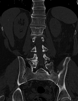 Anterior vertebral scalloping (abdominal aortic aneurysm) (Radiopaedia 66744-76067 Coronal bone window 45).jpg