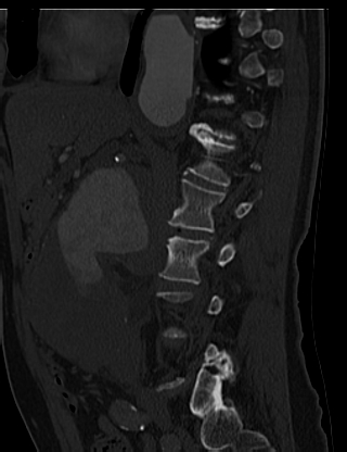 File:Anterior vertebral scalloping (abdominal aortic aneurysm) (Radiopaedia 66744-76067 Sagittal bone window 11).jpg