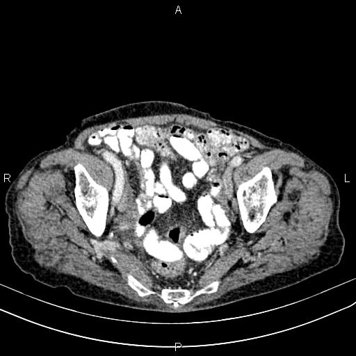 File:Aortic aneurysm and Lemmel syndrome (Radiopaedia 86499-102554 A 68).jpg