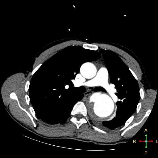 File:Aortic aneurysm and penetrating ulcer (Radiopaedia 23590-23704 A 14).jpg