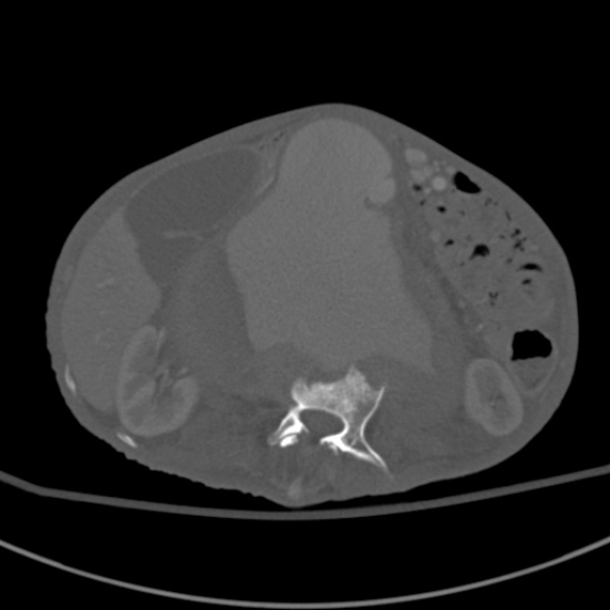 Aortic aneurysm with spinal destruction (Radiopaedia 42301-45410 Axial bone window 41).jpg