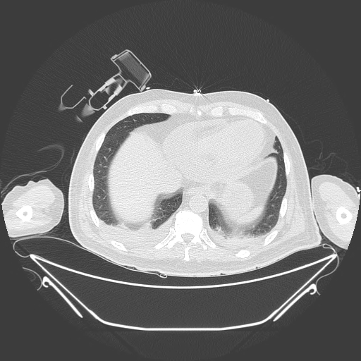 Aortic arch aneurysm (Radiopaedia 84109-99365 Axial lung window 222).jpg