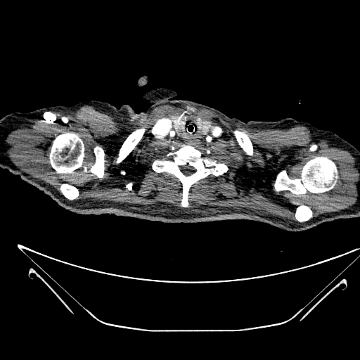 Aortic arch aneurysm (Radiopaedia 84109-99365 B 26).jpg