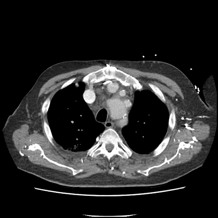 Aortic arch graft infection (FDG PET-CT) (Radiopaedia 71975-82437 A 11).jpg