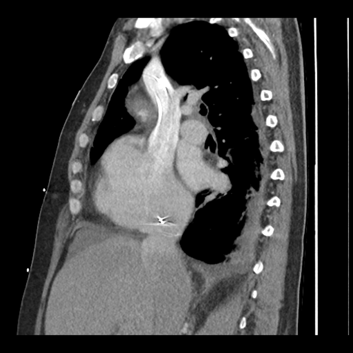 Aortic arch graft infection (FDG PET-CT) (Radiopaedia 71975-82437 C 26).jpg