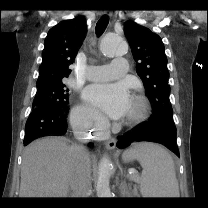 Aortic arch graft infection (FDG PET-CT) (Radiopaedia 71975-82437 Coronal 32).jpg