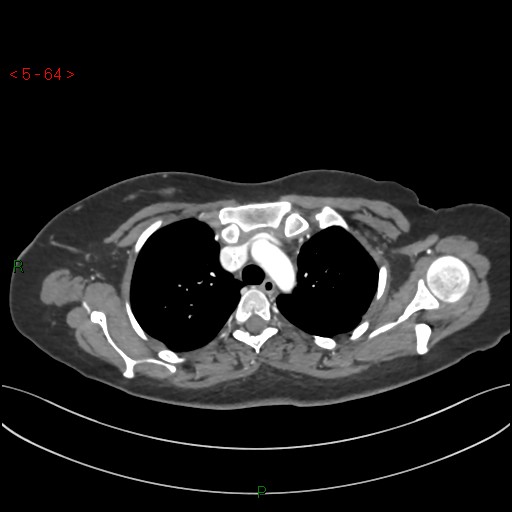 File:Aortic arch origin of left vertebral artery (Radiopaedia 51520-57286 A 63).jpg