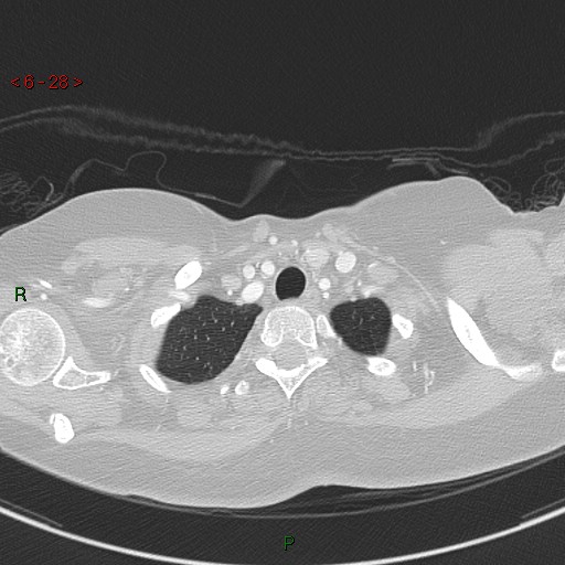 Aortic arch origin of left vertebral artery (Radiopaedia 51520-57286 Axial lung window 28).jpg