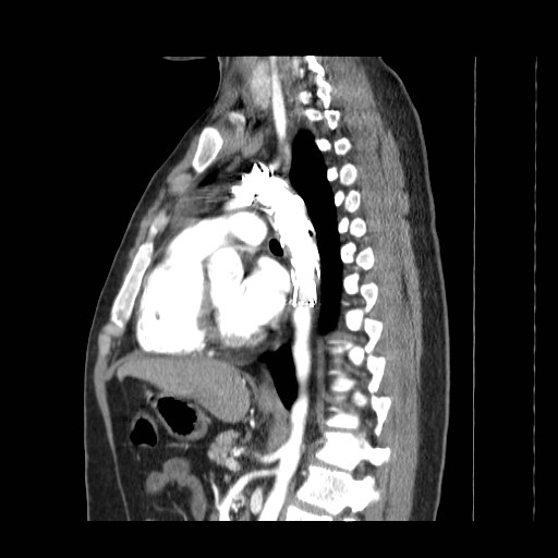 File:Aortic arch stent (Radiopaedia 30030-30595 E 13).jpg
