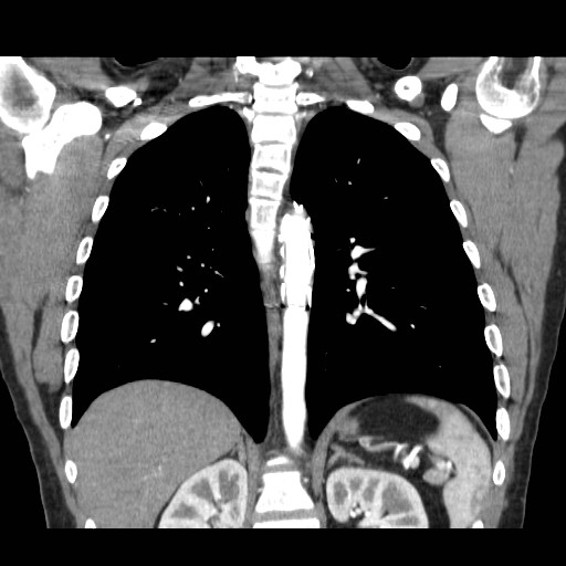 File:Aortic arch stent (Radiopaedia 30030-30595 F 23).jpg