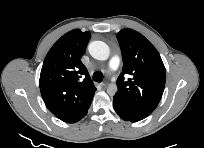 File:Aortic coarctation with aneurysm (Radiopaedia 74818-85828 A 136).jpg