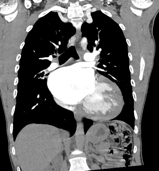Aortic coarctation with aneurysm (Radiopaedia 74818-85828 C 65).jpg