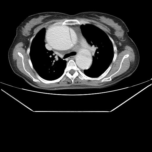 File:Aortic dissection (Radiopaedia 25350-25604 C 16).jpg
