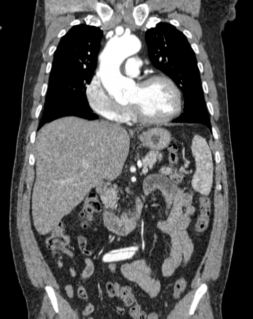 Aortic dissection (Radiopaedia 44411-48061 A 15).jpg