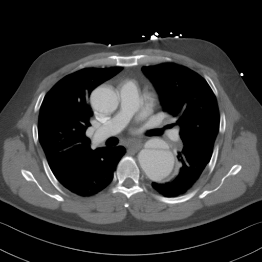 Aortic dissection (Radiopaedia 50763-56234 A 28).png