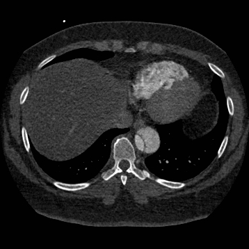 File:Aortic dissection (Radiopaedia 57969-64959 A 234).jpg