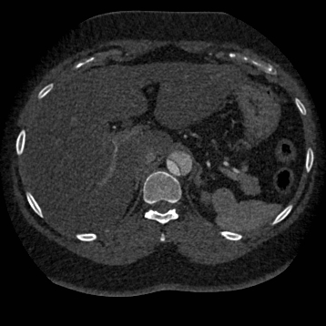 Aortic dissection (Radiopaedia 57969-64959 A 312).jpg