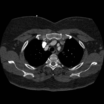 Aortic dissection (Radiopaedia 57969-64959 A 71).jpg