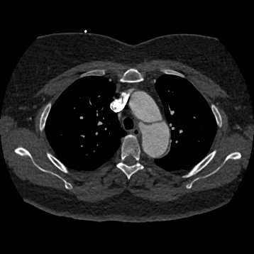 Aortic dissection (Radiopaedia 57969-64959 A 99).jpg