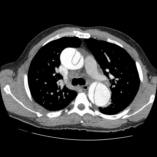 File:Aortic dissection - Stanford A -DeBakey I (Radiopaedia 28339-28587 B 25).jpg