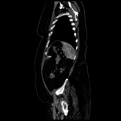 File:Aortic dissection - Stanford type B (Radiopaedia 88281-104910 C 74).jpg