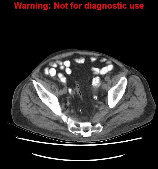 File:Aortic graft infection (Radiopaedia 44979-48907 Axial non-contrast 79).jpg