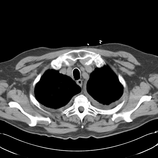 Aortic intramural hematoma (Radiopaedia 34260-35540 Axial non-contrast 11).png