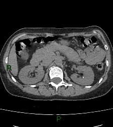 Aortic valve endocarditis (Radiopaedia 87209-103485 Axial non-contrast 107).jpg