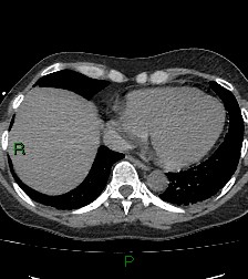 Aortic valve endocarditis (Radiopaedia 87209-103485 Axial non-contrast 75).jpg