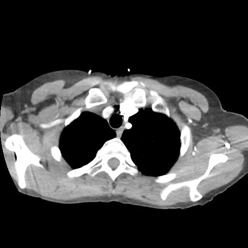 File:Aortic valve non-coronary cusp thrombus (Radiopaedia 55661-62189 B 8).png
