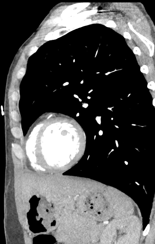Aortic valve non-coronary cusp thrombus (Radiopaedia 55661-62189 C+ arterial phase 12).png