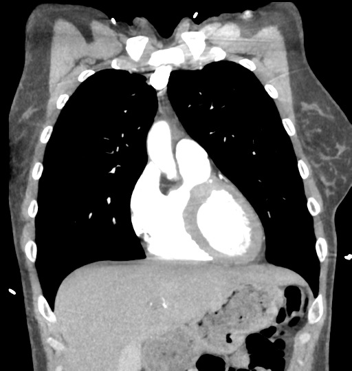 Aortic valve non-coronary cusp thrombus (Radiopaedia 55661-62189 C 25).png