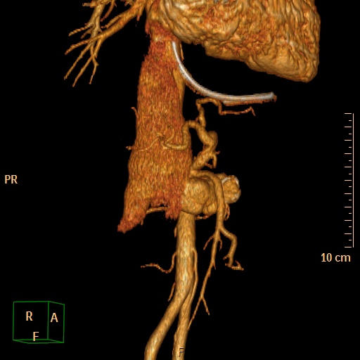 File:Aorto-left renal vein fistula (Radiopaedia 45534-49628 D 12).jpg