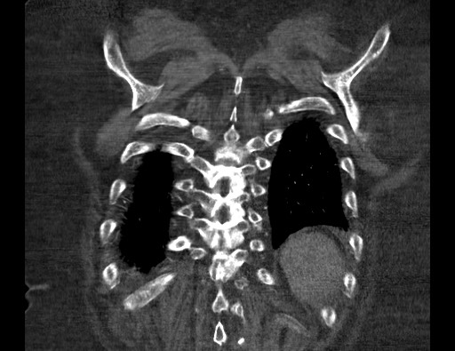 Aortoesophageal fistula with endovascular repair (Radiopaedia 73781-84592 Coronal C+ CTPA 121).jpg