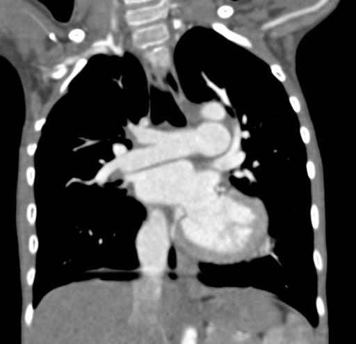 File:Aortopulmonary window, interrupted aortic arch and large PDA giving the descending aorta (Radiopaedia 35573-37074 D 37).jpg