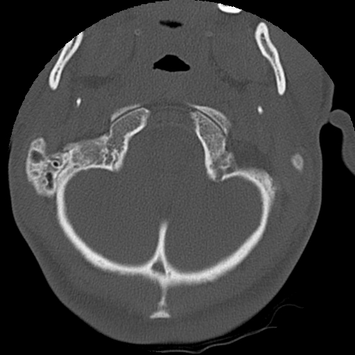 Apical pneumothorax on cervical spine CT (Radiopaedia 45343-49368 Axial bone window 7).jpg