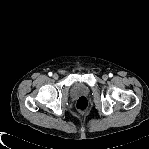 Appendiceal adenocarcinoma complicated by retroperitoneal abscess (Radiopaedia 58007-65039 B 140).jpg