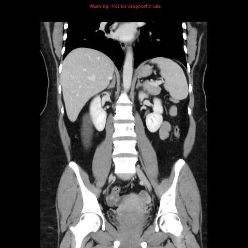 Appendiceal mucinous cystadenoma (Radiopaedia 8263-9111 B 44).jpg