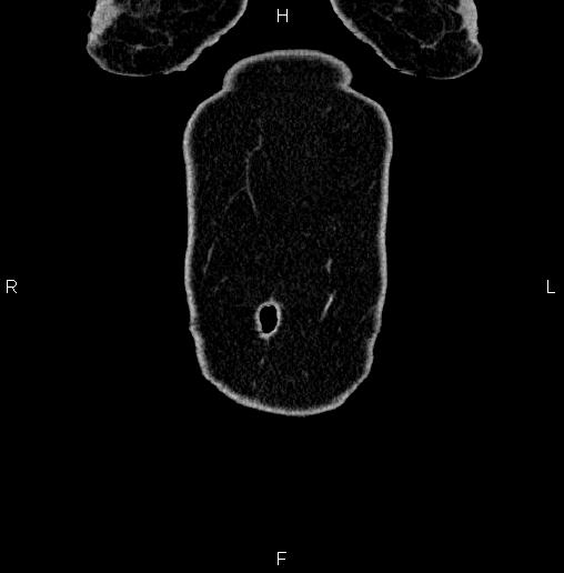 Appendiceal mucocele (Radiopaedia 82952-97298 C 3).jpg