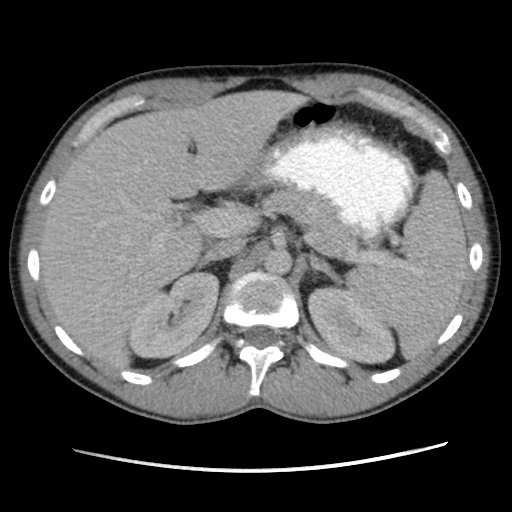File:Appendicitis complicated by post-operative collection (Radiopaedia 35595-37114 A 25).jpg