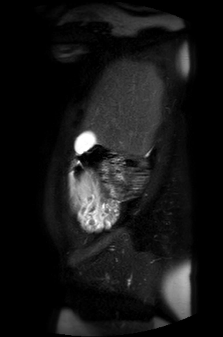 Appendicitis in gravida (MRI) (Radiopaedia 89433-106395 Sagittal T2 SPAIR 54).jpg
