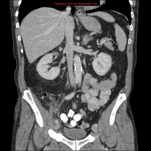 File:Appendicitis mass in inguinal hernia (Radiopaedia 26858-27029 B 36).jpg